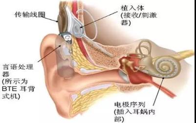 听力保健