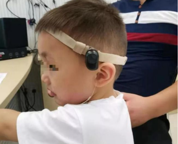 按听损类型看骨导适合哪一种